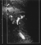Ultrasound image showing vascular malformation