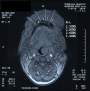 PDT-interstitial treatment-perioperative scan