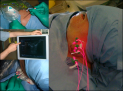 Ultrasound-guided interstitial photodynamic therapy of peri-carotid disease