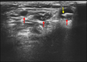 Ultrasound image showing 3 level II metastatic cervical lymph nodes